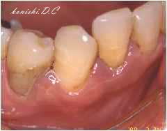 自然 歯茎 治る 腫れ に 歯ぐきが腫れて痛い！膿が臭い！抗生物質が効かないのは何故？